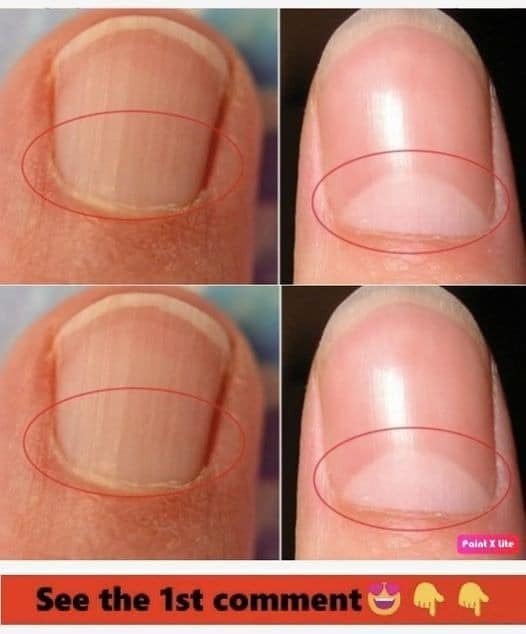 If You Don’t Have A Half Moon Shape On Your Nails, Visit A DOCTOR Immediately.